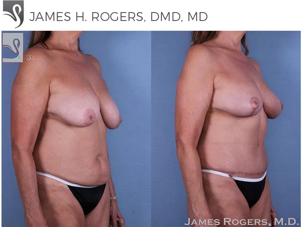 Before and After Image: Mommy Makeover Case #48358 - right-front-oblique