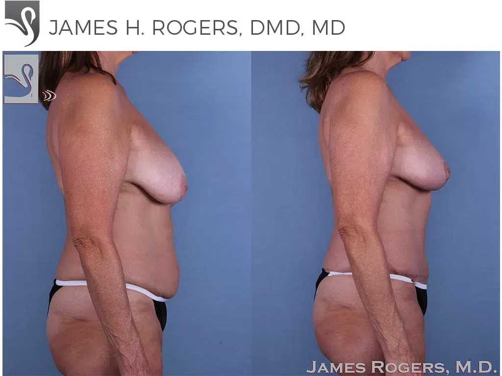 Before and After Image: Mommy Makeover Case #48358 - right-side