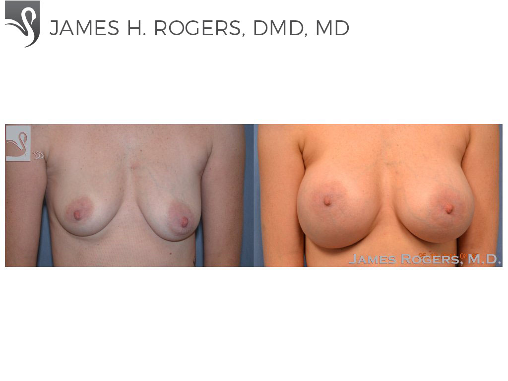 Before and After Image: Breast Augmentation Case #48425 - front