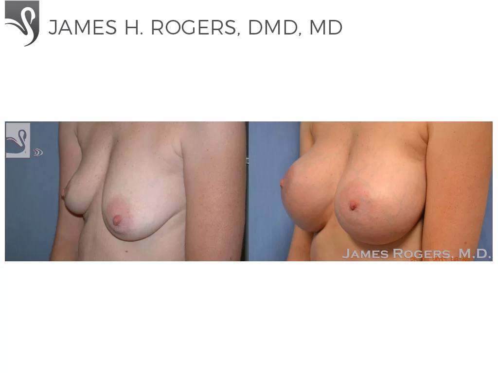 Before and After Image: Breast Augmentation Case #48425 - left-front-oblique