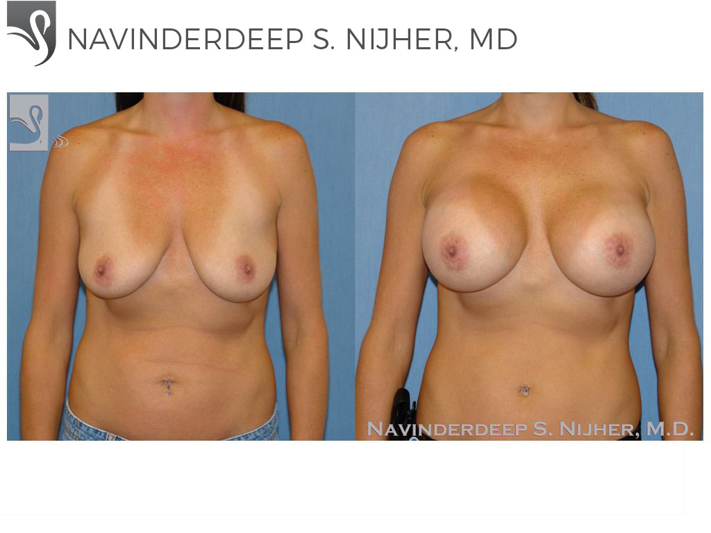 Before and After Image: Breast Augmentation Case #48426 - front