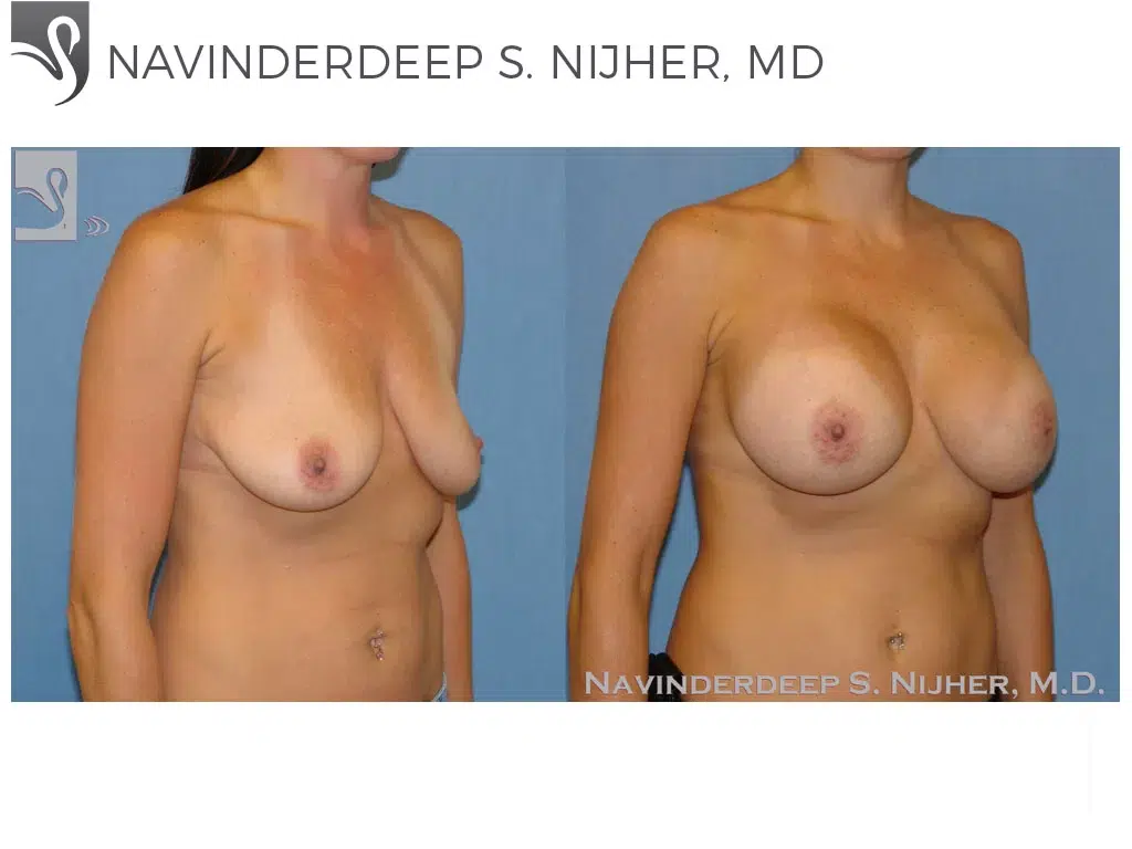 Before and After Image: Breast Augmentation Case #48426 - right-front-oblique