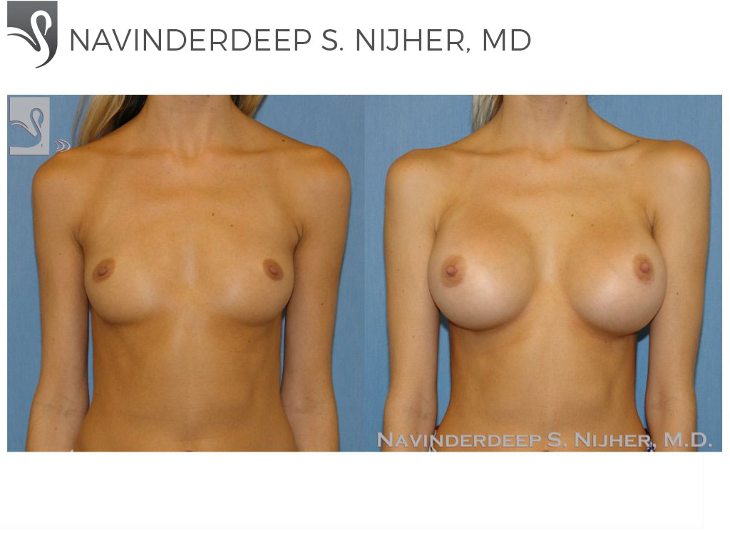 Before and After Image: Breast Augmentation Case #48471 - front