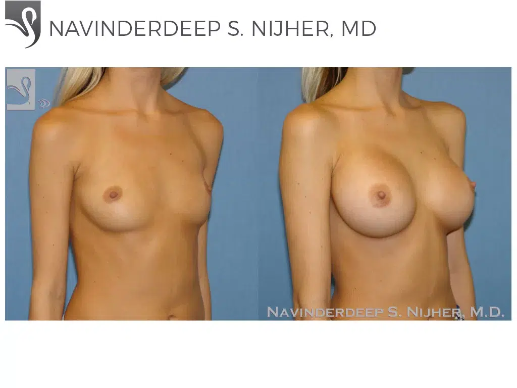 Before and After Image: Breast Augmentation Case #48471 - right-front-oblique