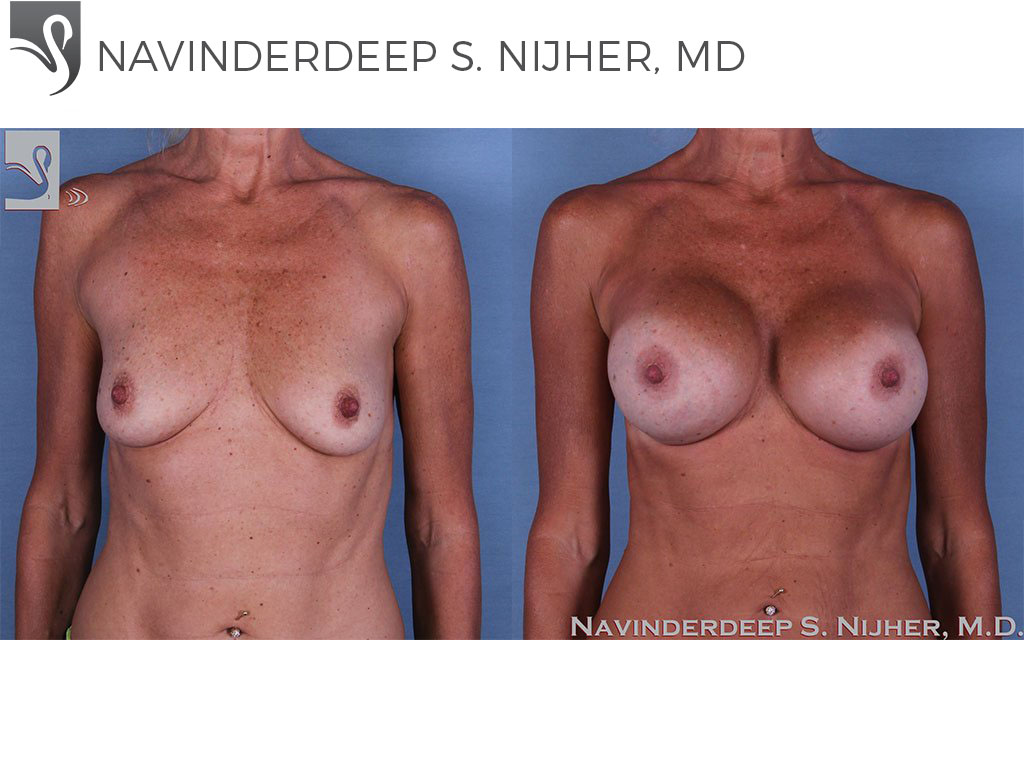 Before and After Image: Breast Augmentation Case #48557 - front