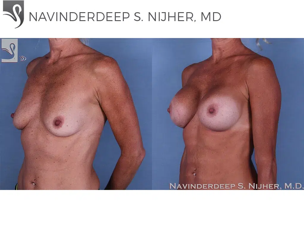 Before and After Image: Breast Augmentation Case #48557 - left-front-oblique