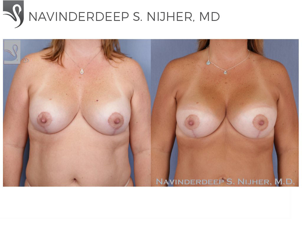 Before and After Image: Breast Revisions Case #48614 - front