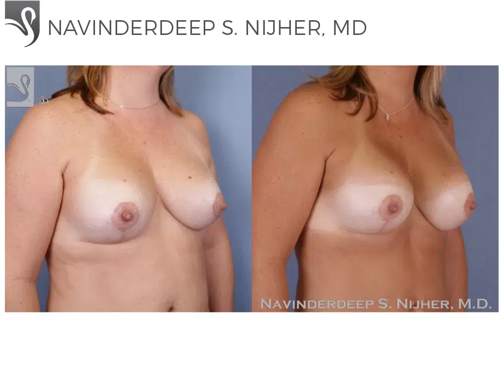 Before and After Image: Breast Revisions Case #48614 - right-front-oblique