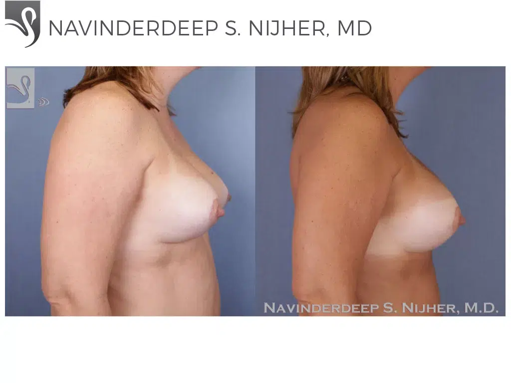 Before and After Image: Breast Revisions Case #48614 - right-side