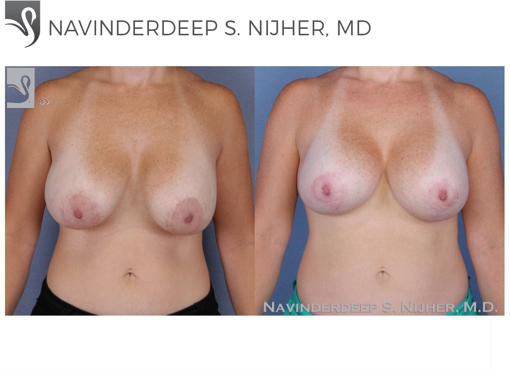 Before and After Image: Breast Revisions Case #48643 - front