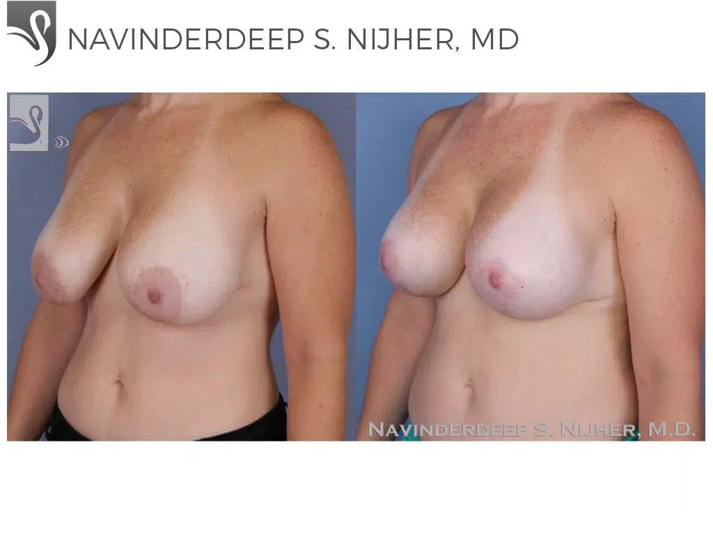 Before and After Image: Breast Revisions Case #48643 - left-front-oblique