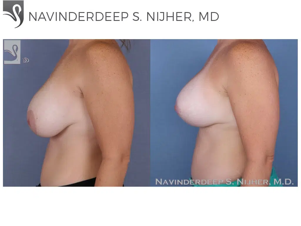Before and After Image: Breast Revisions Case #48643 - left-side
