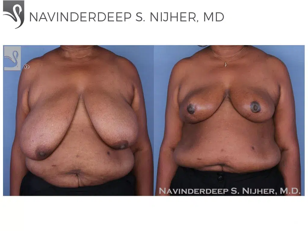 Before and After Image: Female Breast Reduction Case #48963 - front