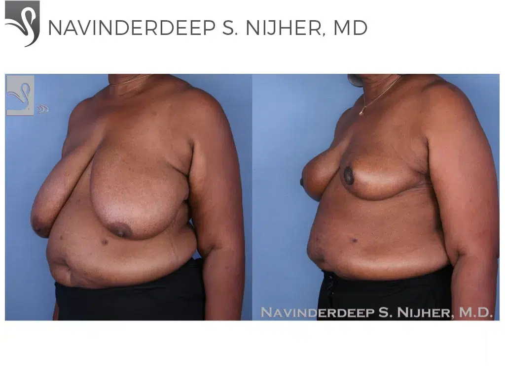 Before and After Image: Female Breast Reduction Case #48963 - left-front-oblique