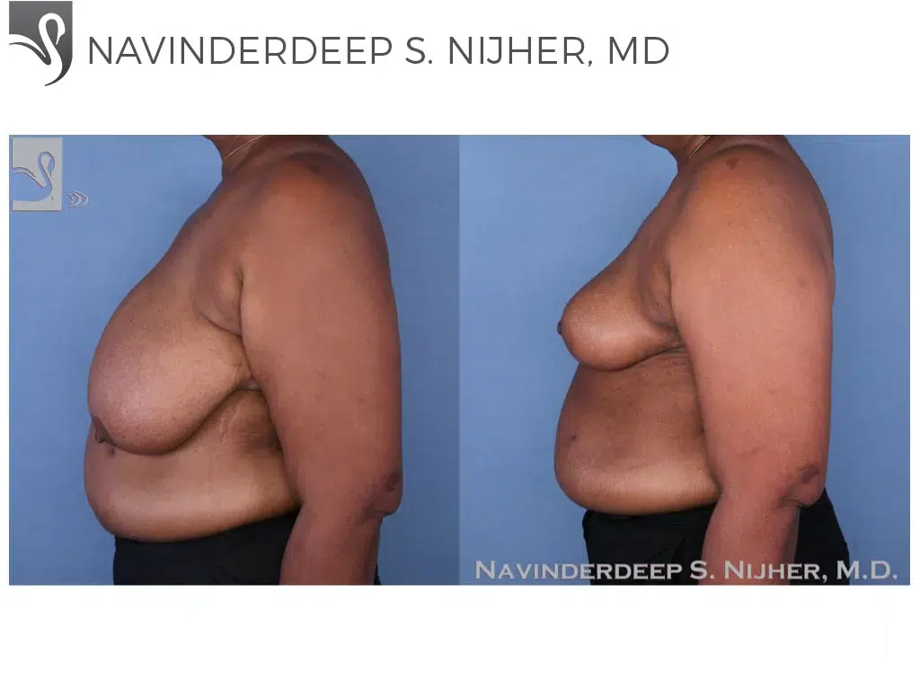 Before and After Image: Female Breast Reduction Case #48963 - left-side