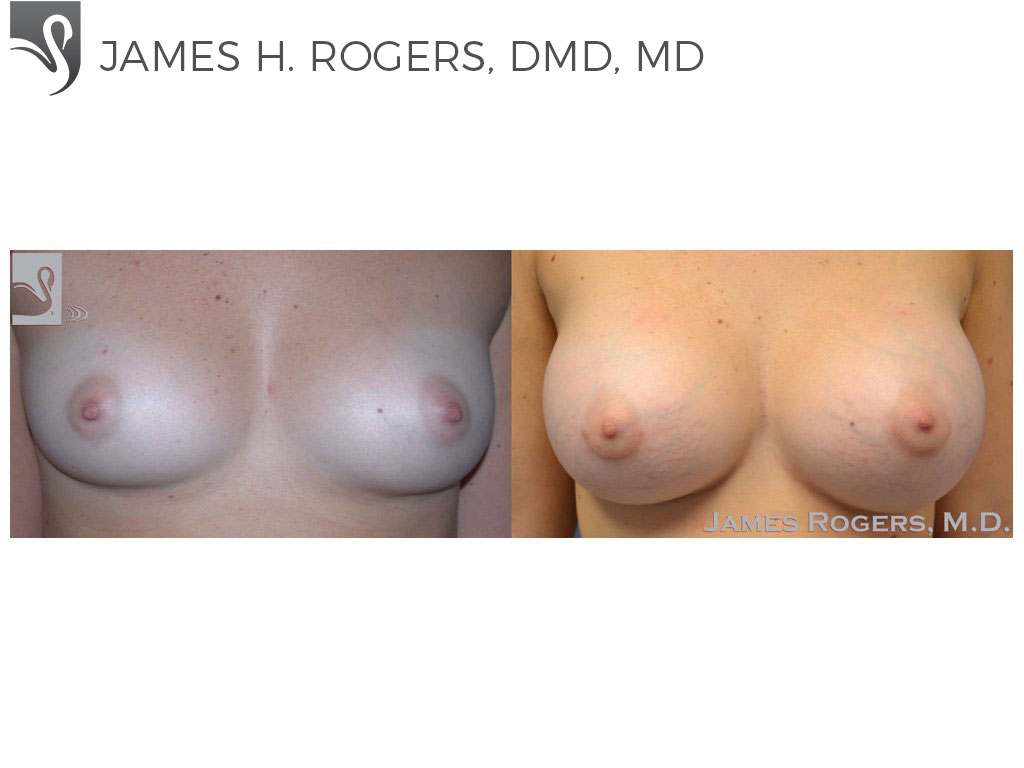 Before and After Image: Breast Augmentation Case #48966 - front