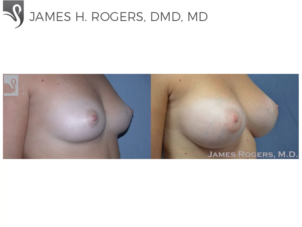 Before and After Image: Breast Augmentation Case #48966 - right-front-oblique