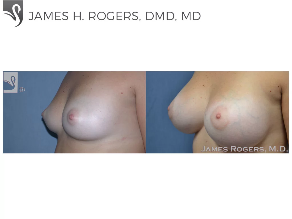 Before and After Image: Breast Augmentation Case #48966 - left-front-oblique