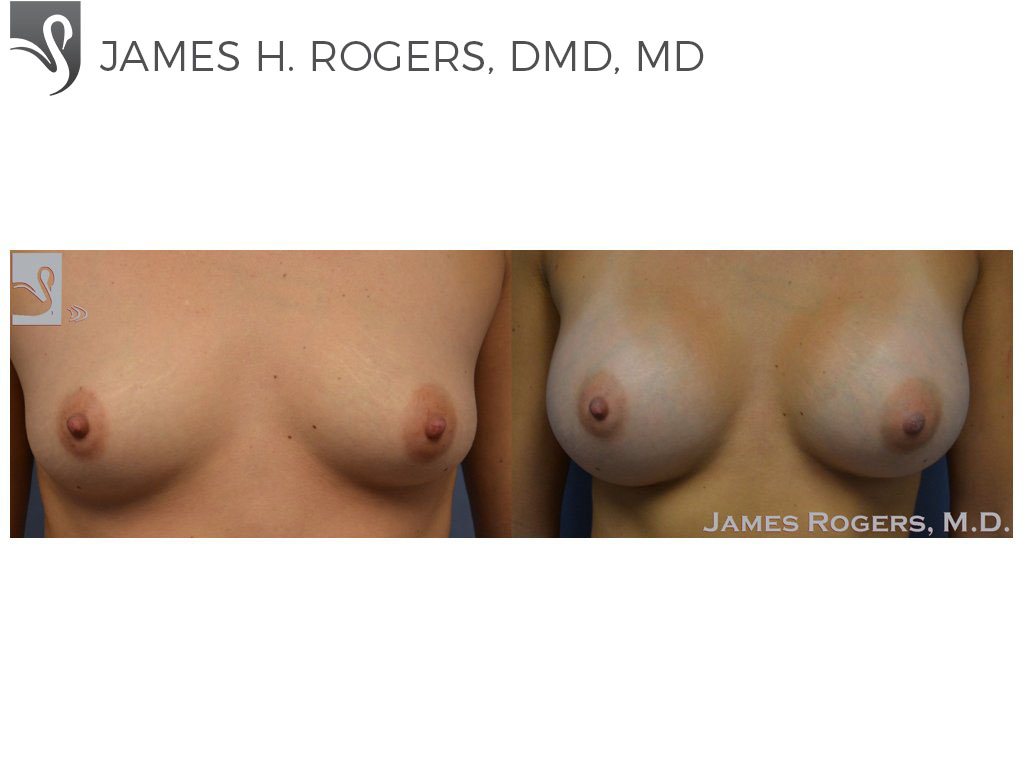 Before and After Image: Breast Augmentation Case #48986 - front