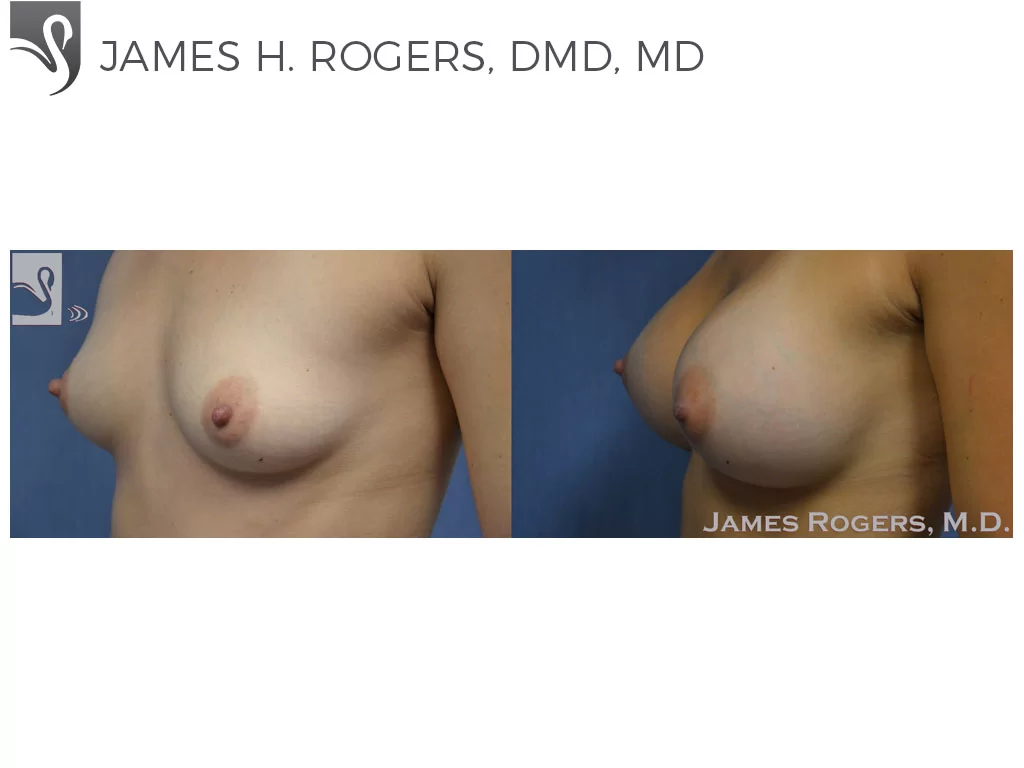 Before and After Image: Breast Augmentation Case #48986 - left-front-oblique