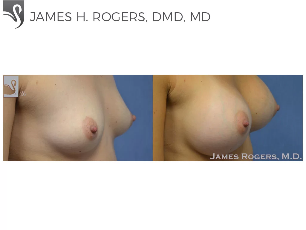 Before and After Image: Breast Augmentation Case #48986 - right-front-oblique