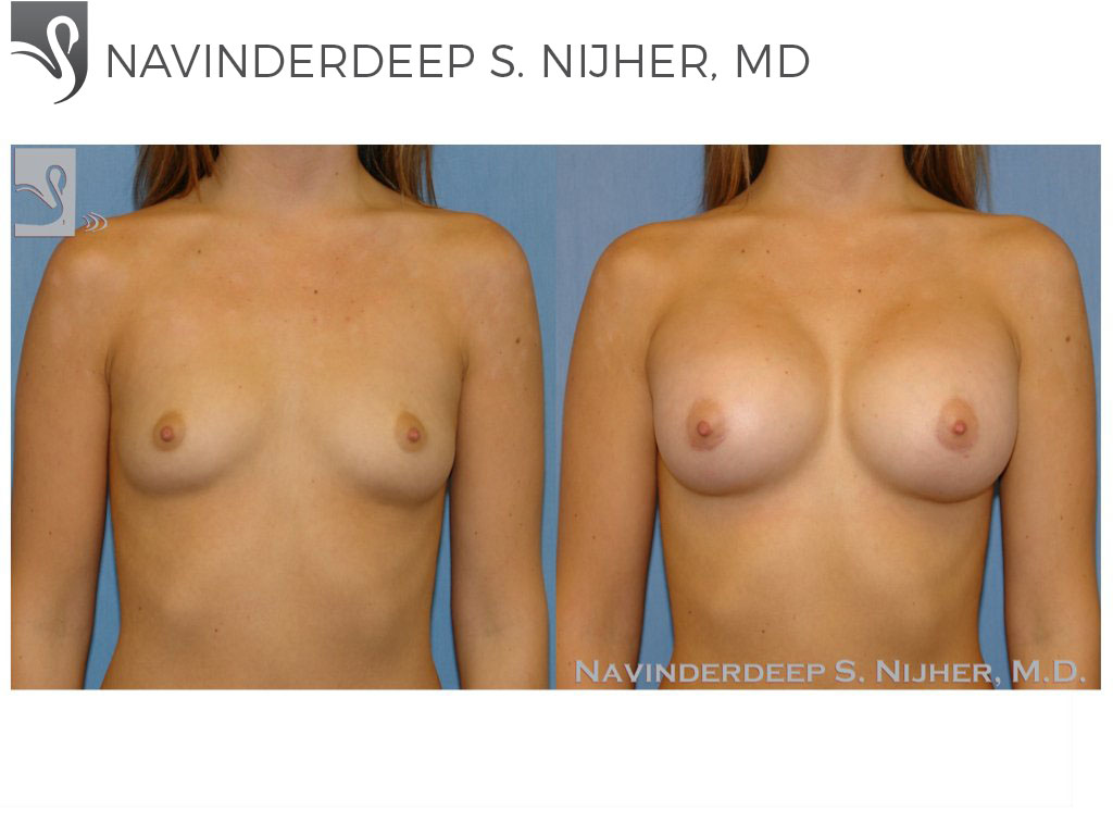 Before and After Image: Breast Augmentation Case #49149 - front