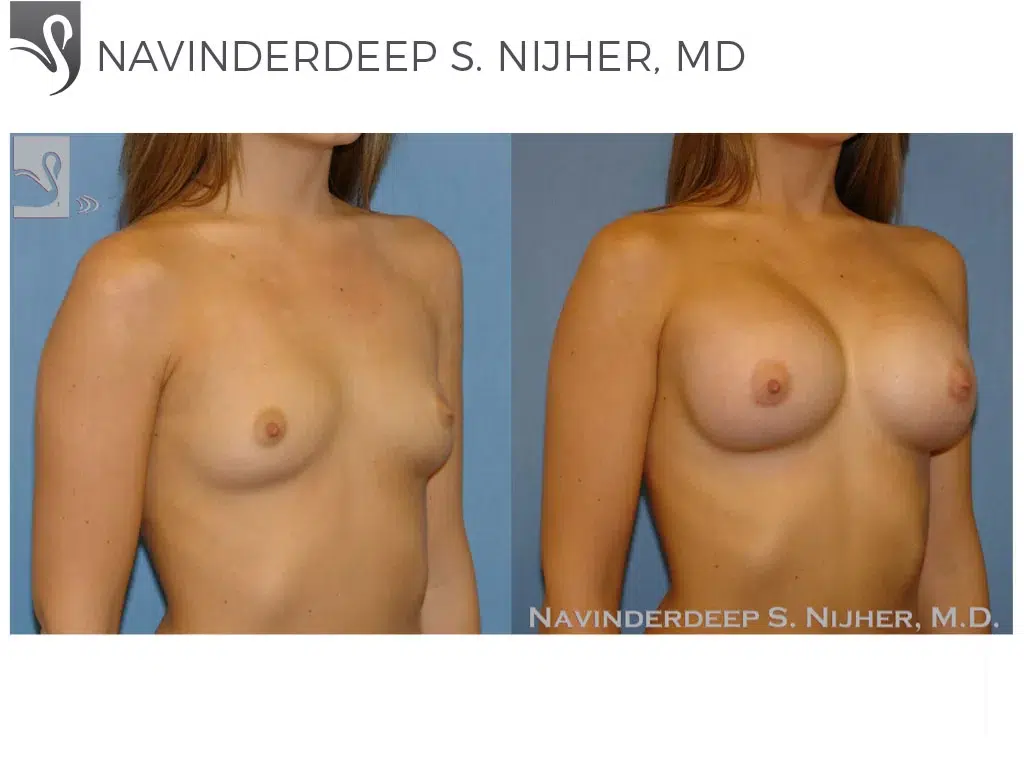 Before and After Image: Breast Augmentation Case #49149 - right-front-oblique