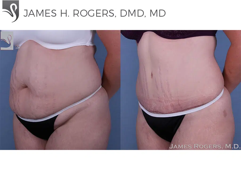 Before and After Image: Abdominoplasty (Tummy Tuck) Case #49214 - left-front-oblique