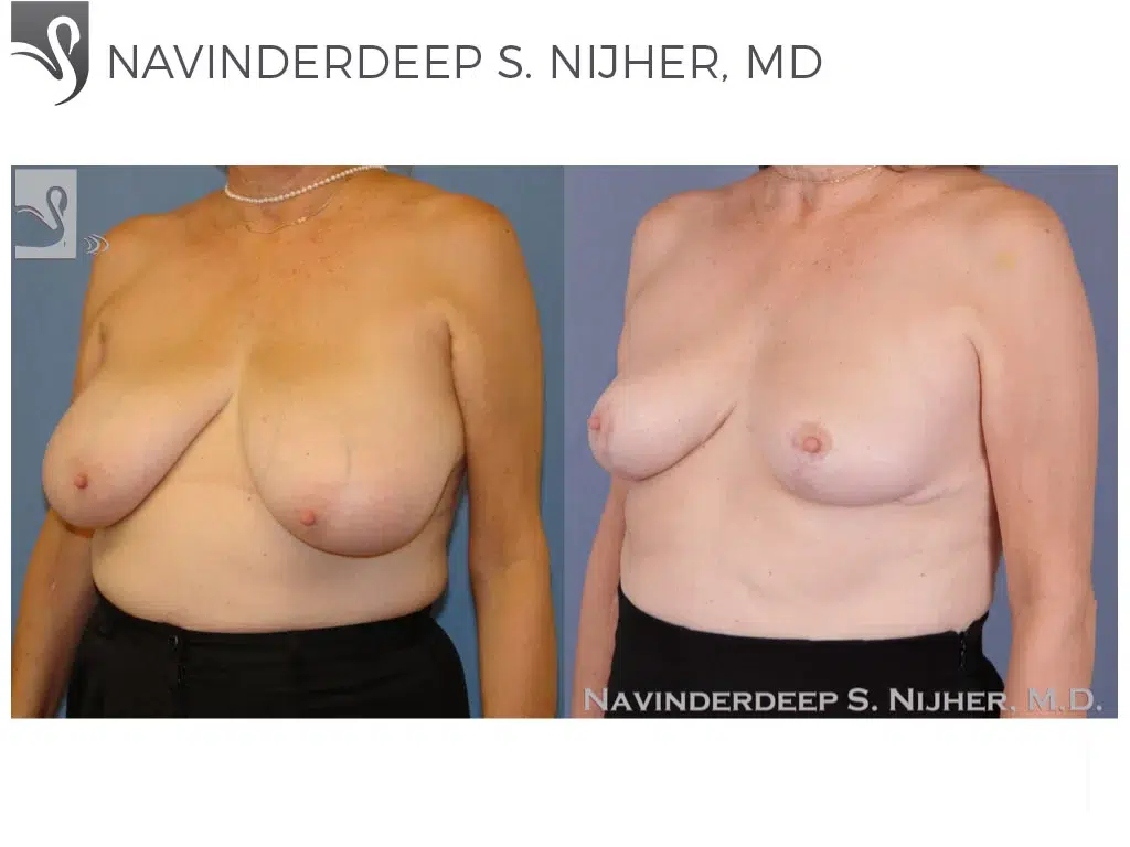 Before and After Image: Female Breast Reduction Case #49304 - left-front-oblique