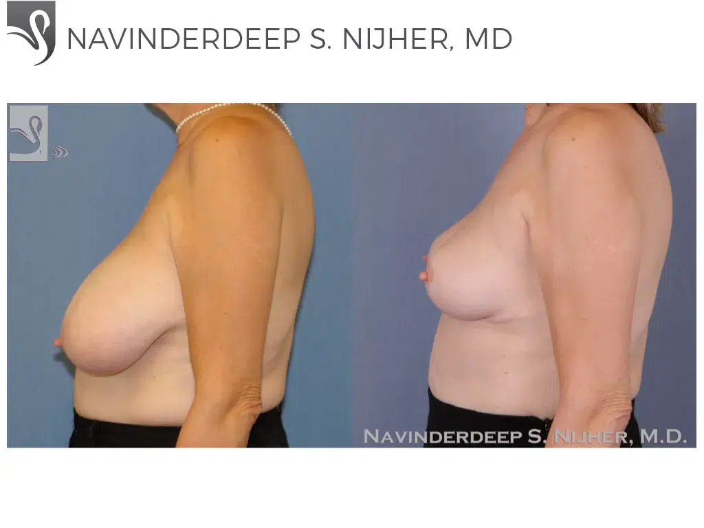 Before and After Image: Female Breast Reduction Case #49304 - left-side