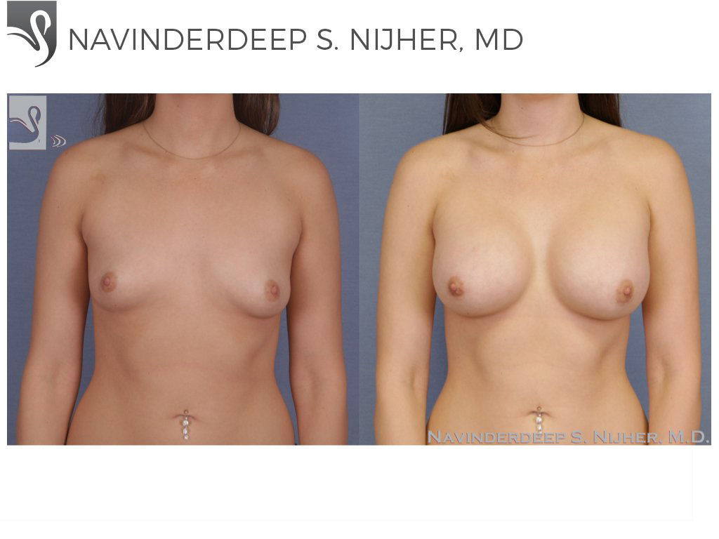 Before and After Image: Breast Augmentation Case #49713 - front