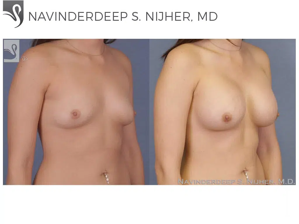 Before and After Image: Breast Augmentation Case #49713 - right-front-oblique