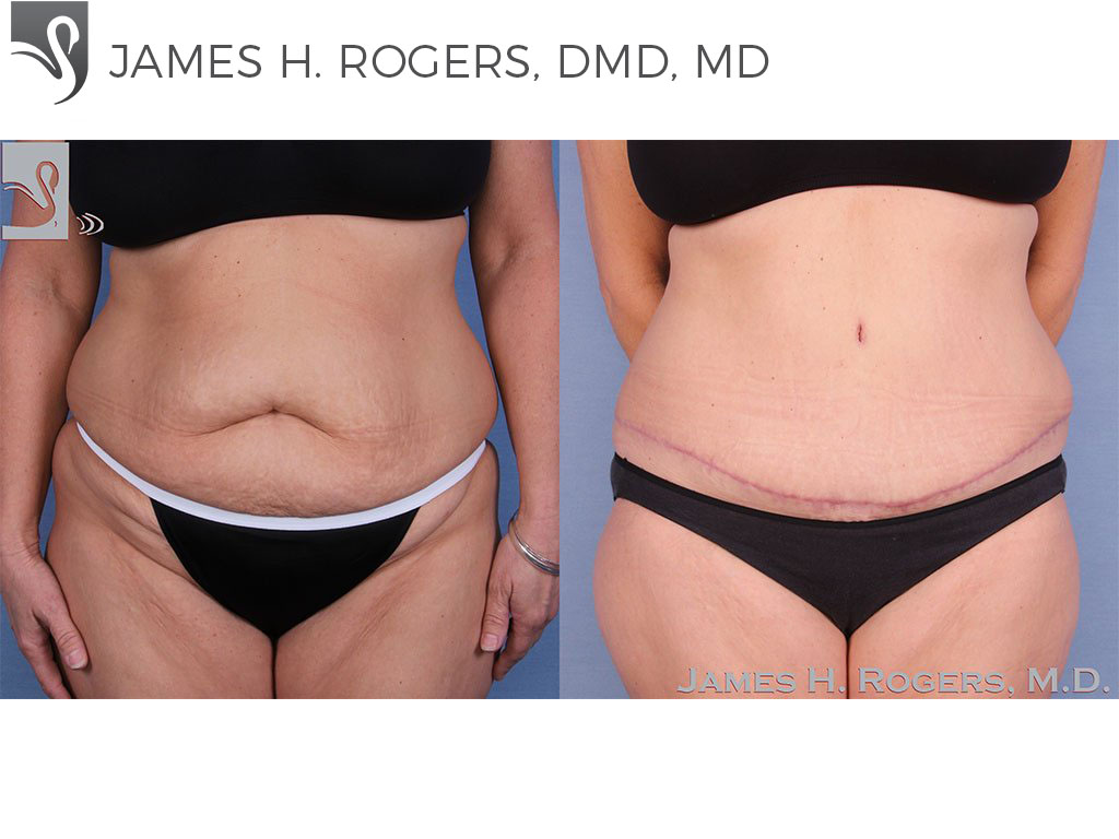 Before and After Image: Abdominoplasty (Tummy Tuck) Case #50016 - front