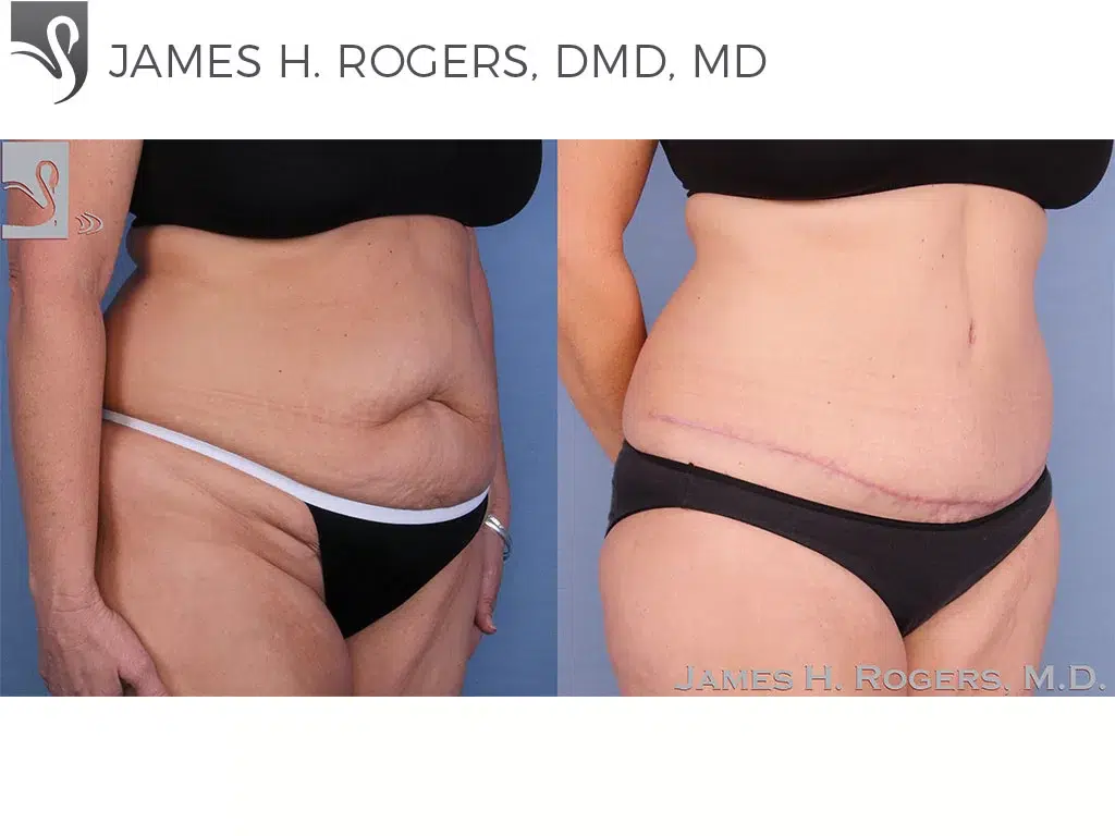 Before and After Image: Abdominoplasty (Tummy Tuck) Case #50016 - right-front-oblique
