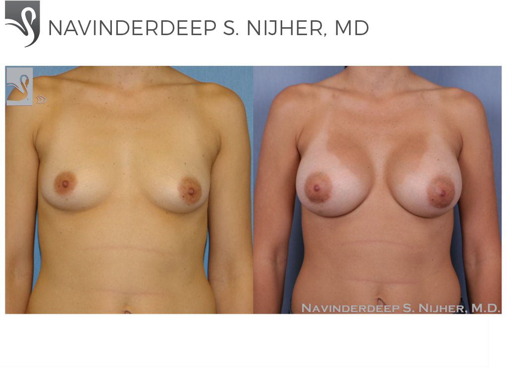 Before and After Image: Breast Augmentation Case #50064 - front