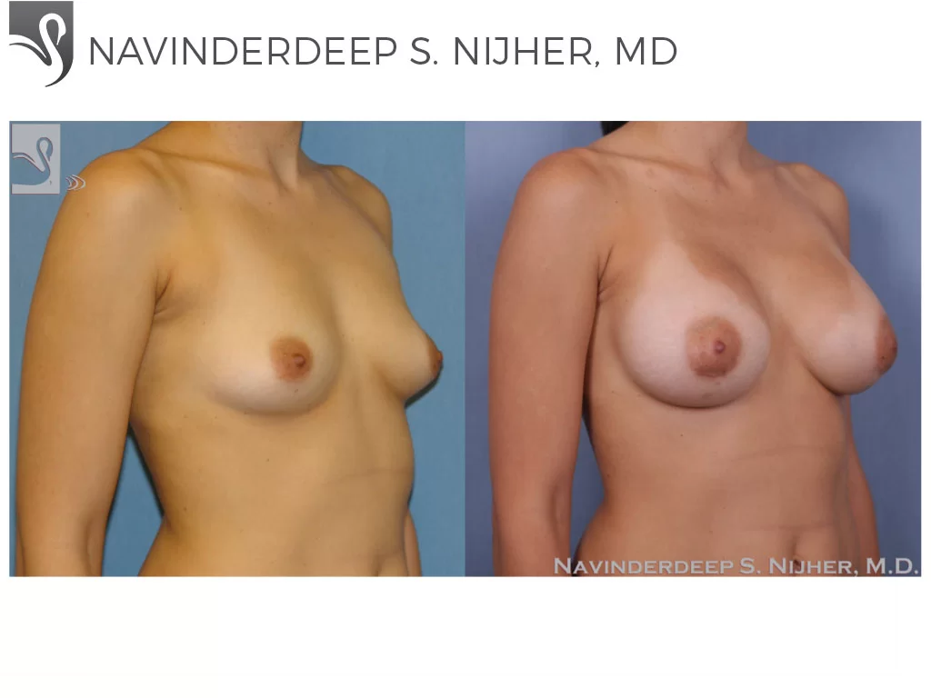 Before and After Image: Breast Augmentation Case #50064 - right-front-oblique