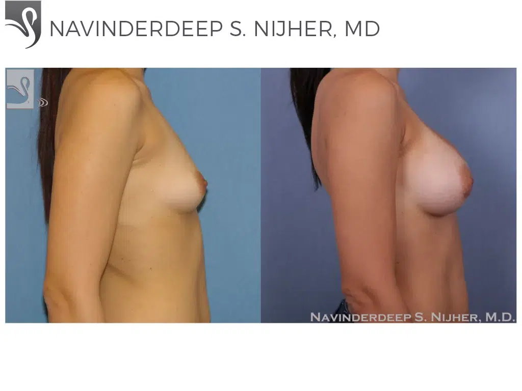 Before and After Image: Breast Augmentation Case #50064 - right-side