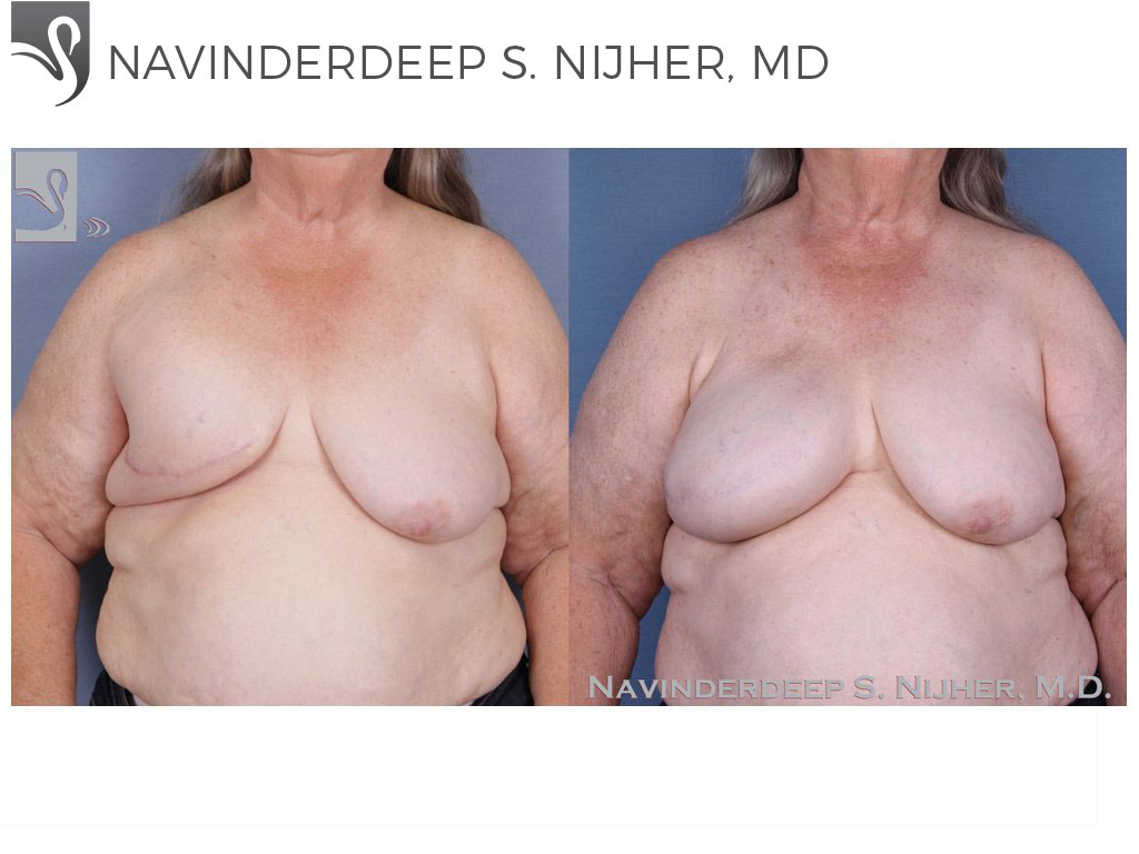 Before and After Image: Breast Reconstruction Case #50111 - front