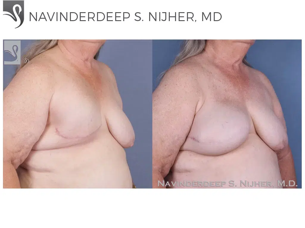 Before and After Image: Breast Reconstruction Case #50111 - right-front-oblique