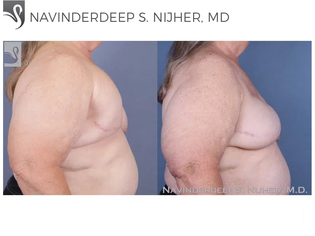 Before and After Image: Breast Reconstruction Case #50111 - right-side