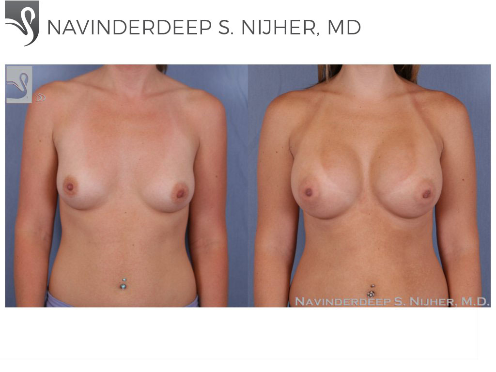 Before and After Image: Breast Augmentation Case #50168 - front