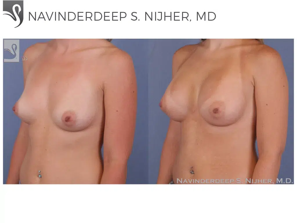 Before and After Image: Breast Augmentation Case #50168 - left-front-oblique