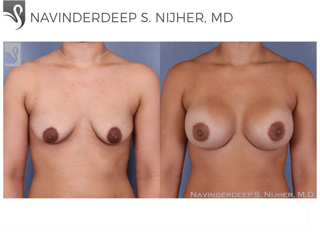 Before and After Image: Breast Augmentation Case #50195 - front