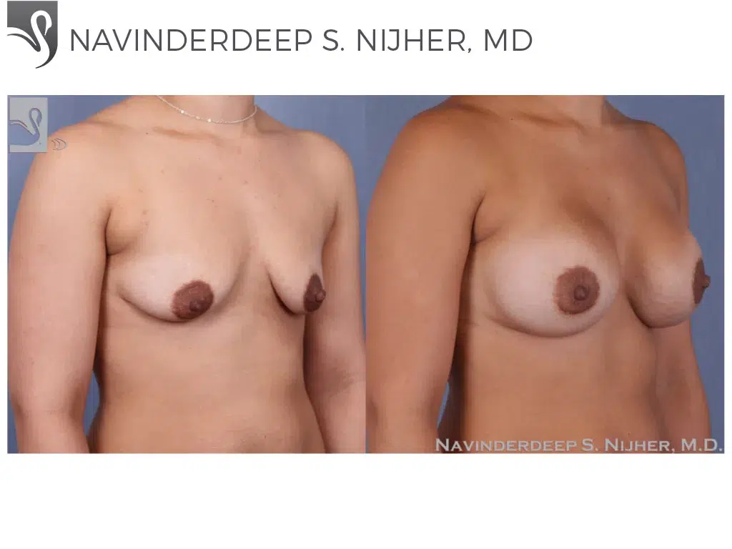 Before and After Image: Breast Augmentation Case #50195 - right-front-oblique