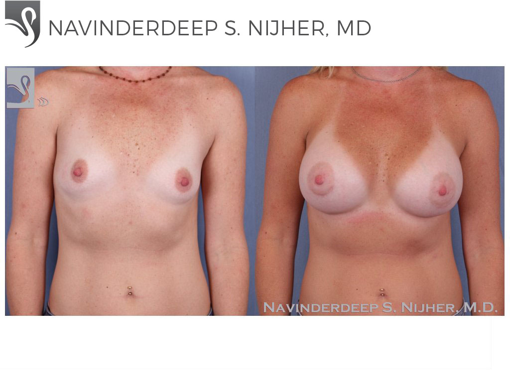 Before and After Image: Breast Augmentation Case #50285 - front