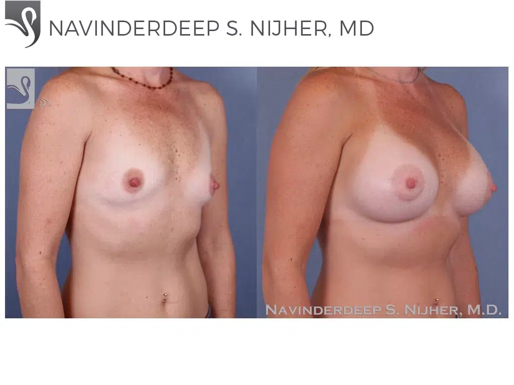 Before and After Image: Breast Augmentation Case #50285 - right-front-oblique