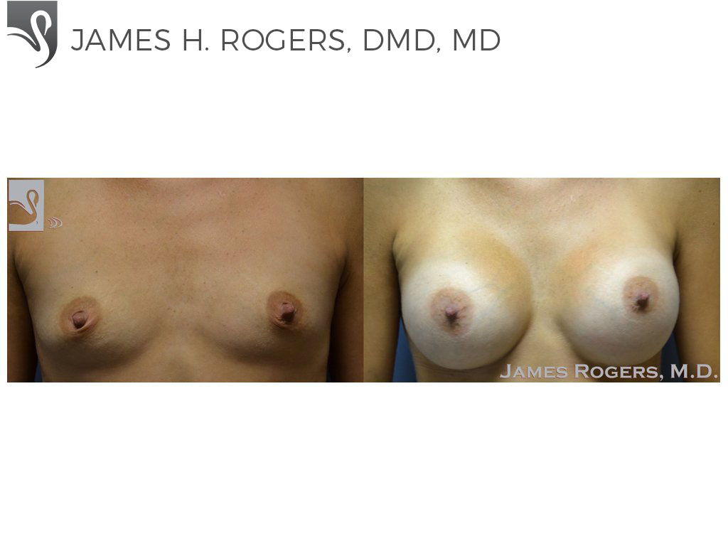 Before and After Image: Breast Augmentation Case #50333 - front