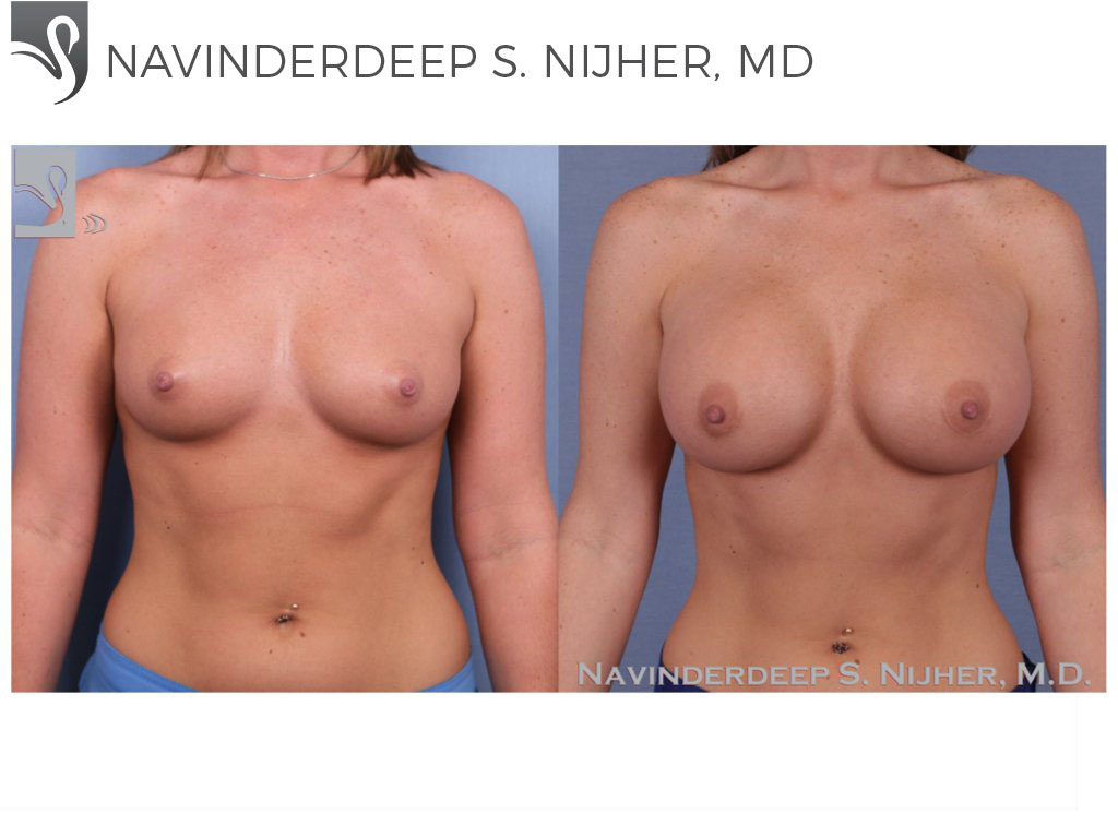 Before and After Image: Breast Augmentation Case #50343 - front