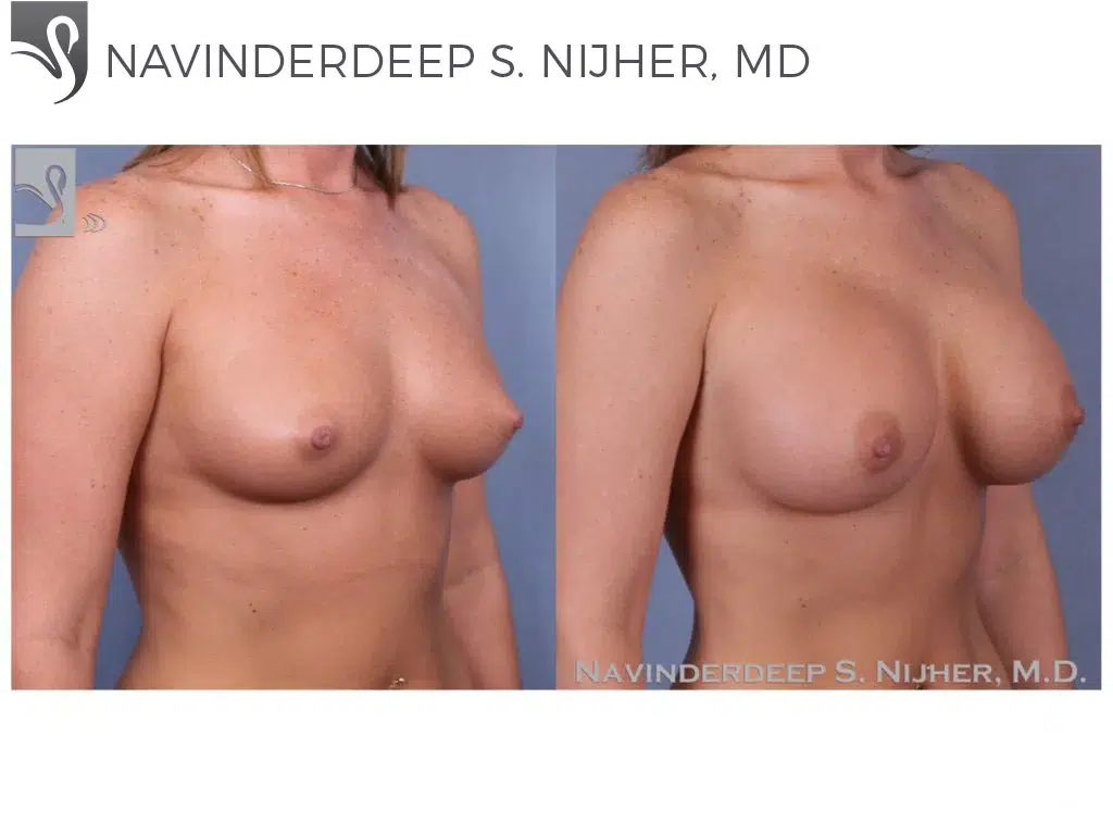 Before and After Image: Breast Augmentation Case #50343 - right-front-oblique