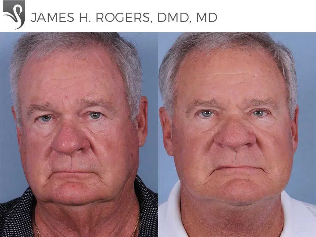 Before and After Image: Face Lift Case #50352